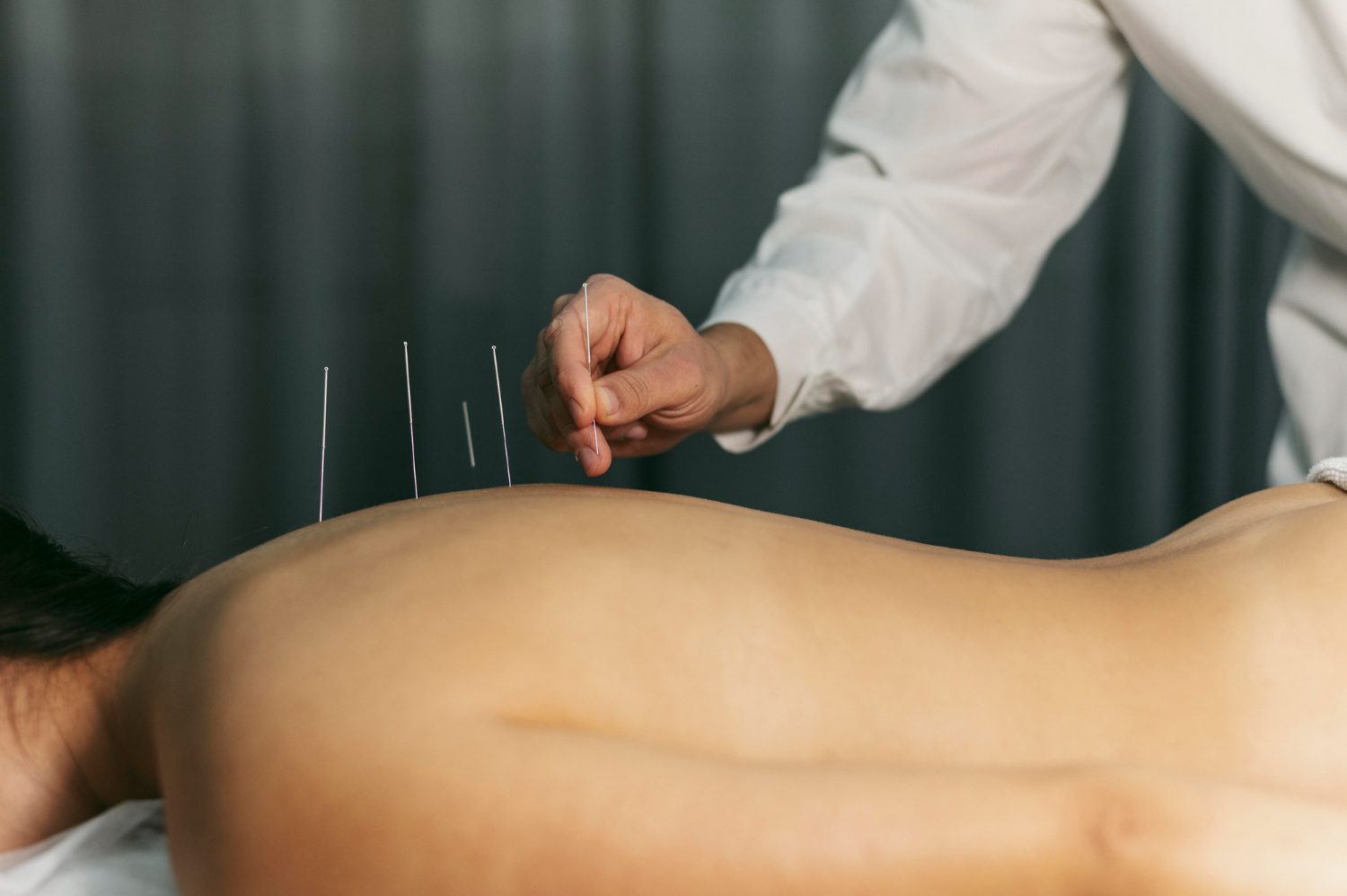 Acupuncture Acupuncture