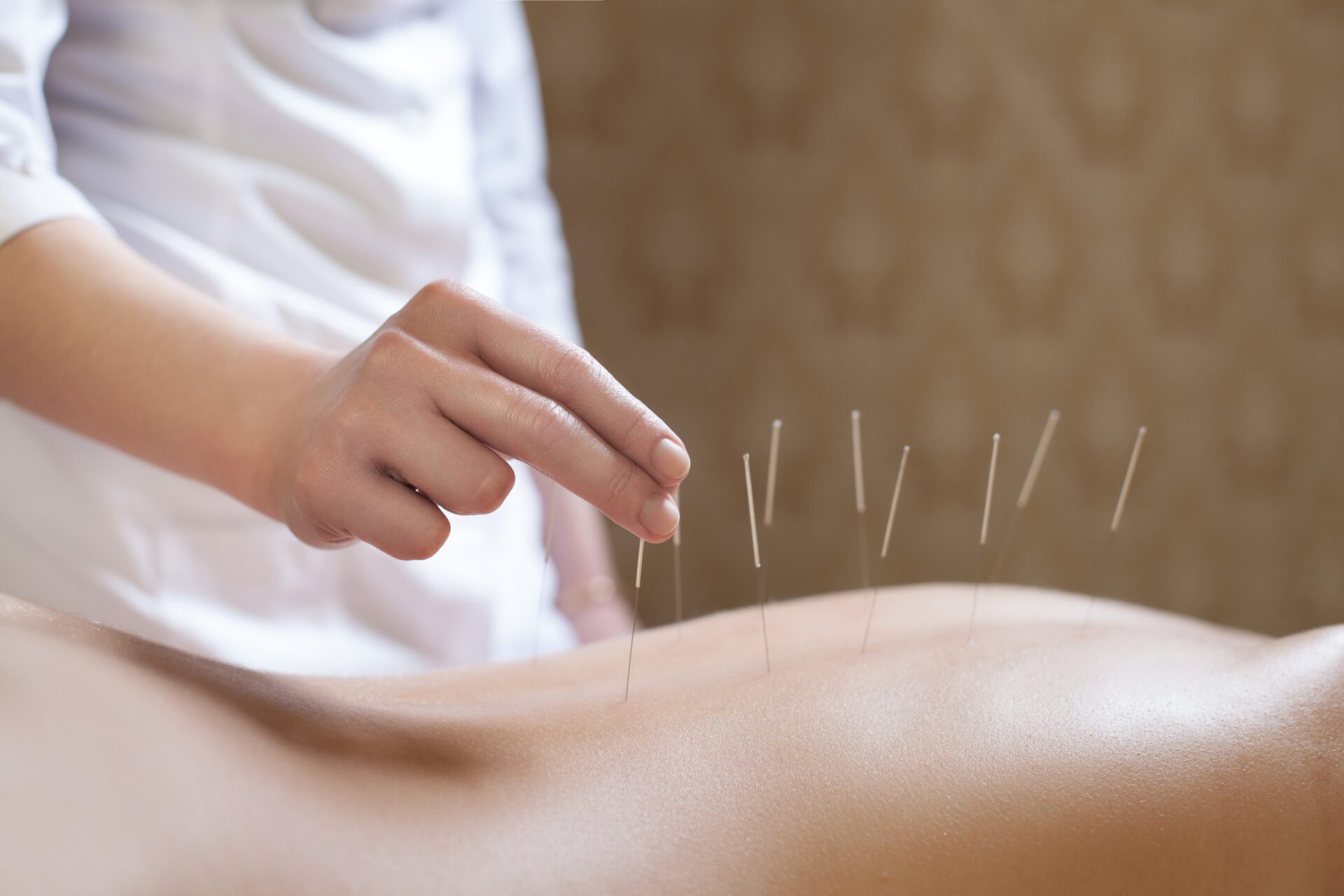 needle acupuncture procedure; needle acupuncture procedure;